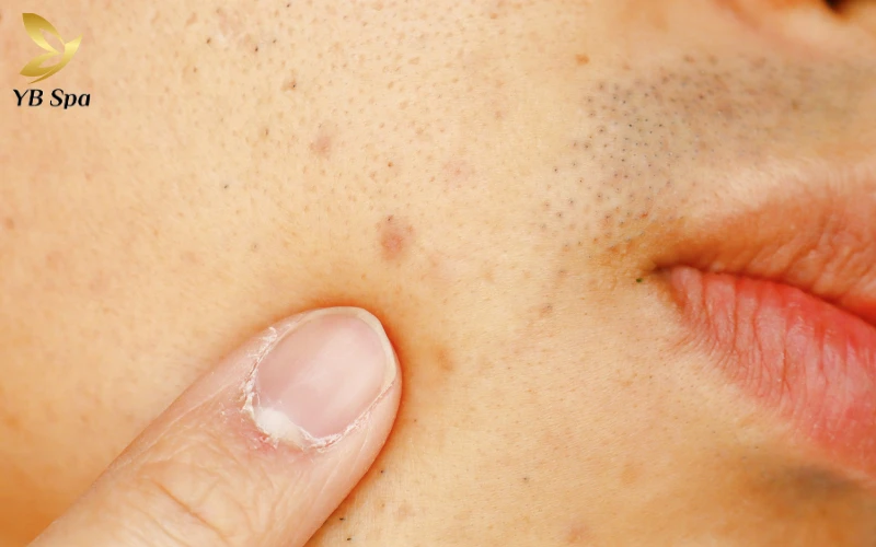 Thâm mụn là gì?