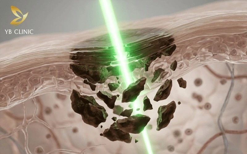Trị Thâm Nách Bằng Laser Có Hiệu Quả Không? Quy Trình, Chi Phí Và Lưu Ý 7 Công nghệ laser phá hủy các sắc tố melanin nằm sâu dưới biểu bì, giúp da nách sáng mịn.