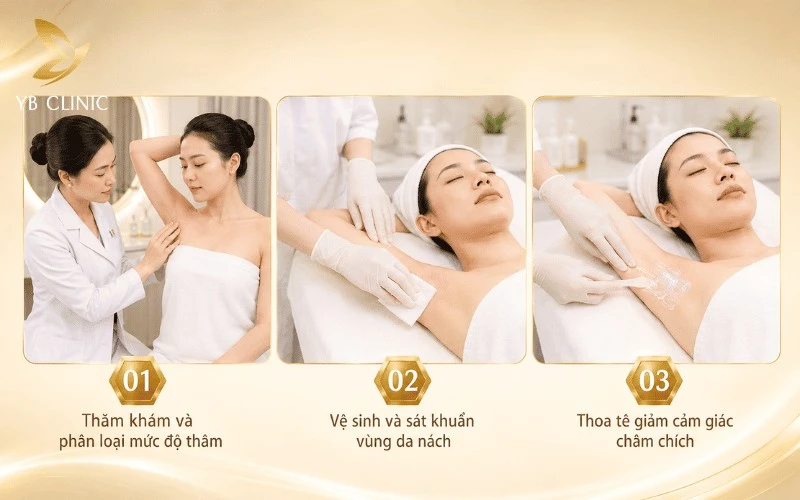 Trị Thâm Nách Bằng Laser Có Hiệu Quả Không? Quy Trình, Chi Phí Và Lưu Ý 9 Quy trình trị thâm nách bằng laser bắt đầu với thăm khám, vệ sinh sát khuẩn và thoa tê nhằm đảm bảo an toàn, hạn chế khó chịu trước khi điều trị.