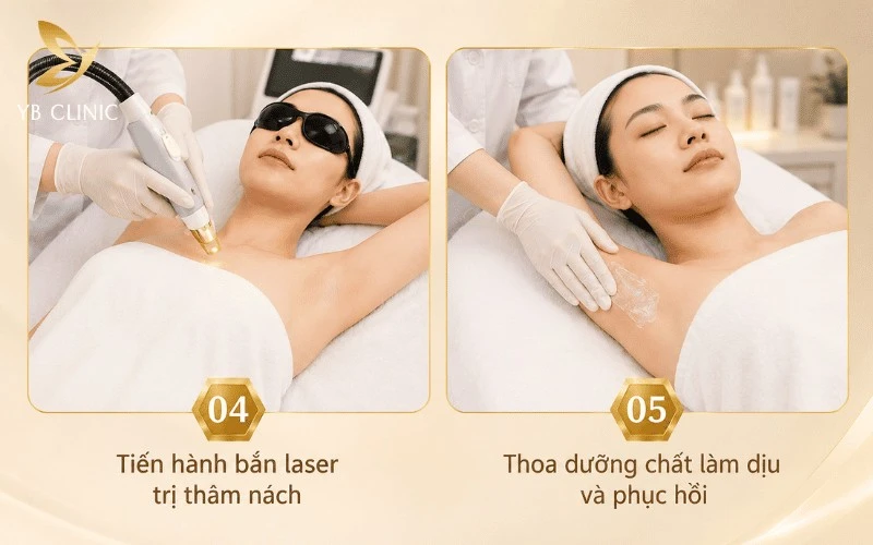 Trị Thâm Nách Bằng Laser Có Hiệu Quả Không? Quy Trình, Chi Phí Và Lưu Ý 10 Sau khi bắn laser trị thâm nách, vùng da được thoa dưỡng chất chuyên dụng nhằm làm dịu, cấp ẩm và hỗ trợ quá trình phục hồi.
