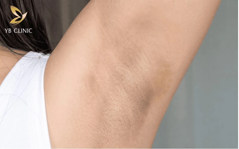 Trị Thâm Nách Công Nghệ Cao Có Hiệu Quả Không? Quy Trình Và Bảng Giá 13 Thâm biểu bì vùng nách thường xuất phát từ ma sát thường xuyên và sự tích tụ tế bào chết trên bề mặt da, khiến vùng da trở nên xỉn màu.