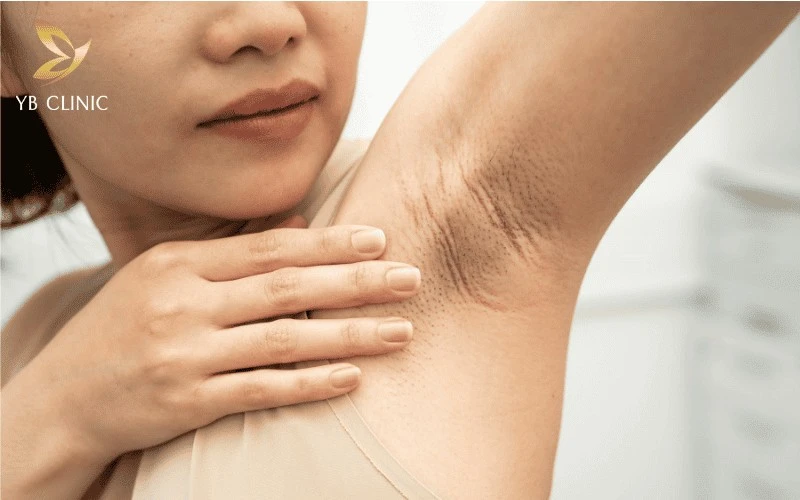 Trị Thâm Nách Công Nghệ Cao Có Hiệu Quả Không? Quy Trình Và Bảng Giá 16 Các ca thâm nách lâu năm hoặc thâm do nội tiết tố đòi hỏi chi phí cao hơn do phác đồ điều trị phức tạp.