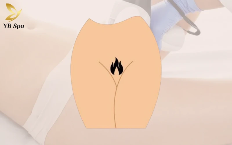 Triệt Lông Bikini Tạo Hình Là Gì? Các Mẫu Tạo Hình Triệt Lông Bikini Phổ Biến 35 Triệt Lông Bikini Tạo Hình Ngọn Lửa