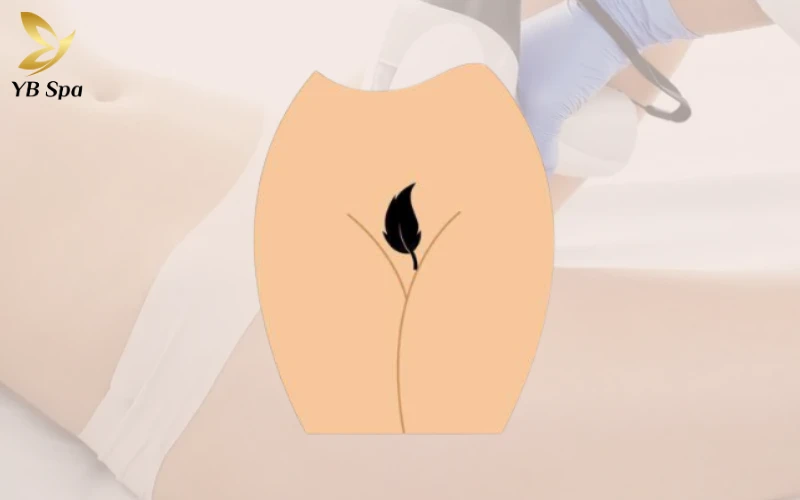 Triệt Lông Bikini Tạo Hình Là Gì? Các Mẫu Tạo Hình Triệt Lông Bikini Phổ Biến 36 Triệt Lông Bikini Hình Chiếc Lá