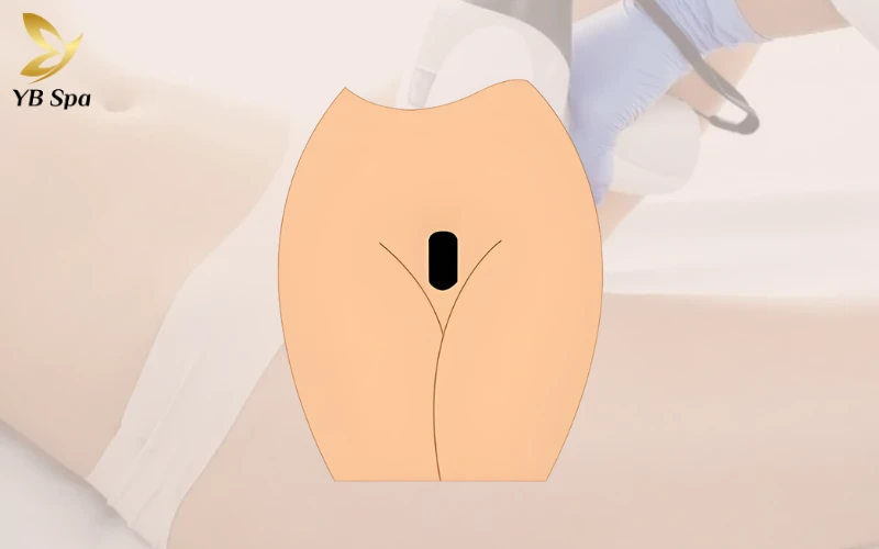 Triệt Lông Bikini Tạo Hình Là Gì? Các Mẫu Tạo Hình Triệt Lông Bikini Phổ Biến 37 Triệt Lông Bikini Tạo Hình California