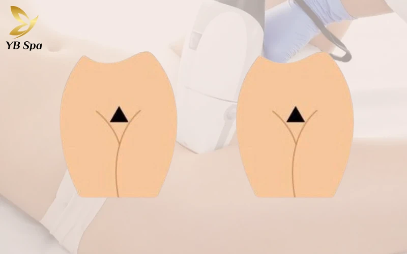 Triệt Lông Bikini Tạo Hình Là Gì? Các Mẫu Tạo Hình Triệt Lông Bikini Phổ Biến 27 Triệt Lông Bikini Tạo Hình Tam Giác