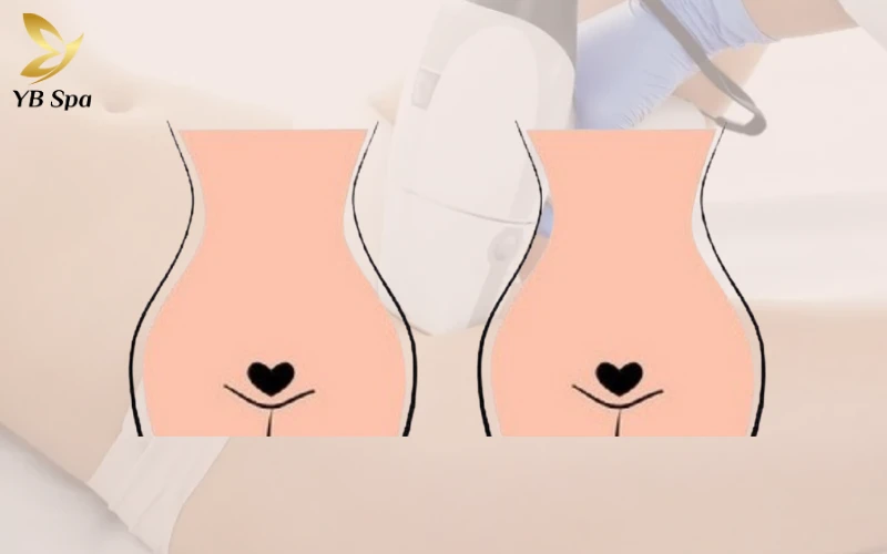 Triệt Lông Bikini Tạo Hình Là Gì? Các Mẫu Tạo Hình Triệt Lông Bikini Phổ Biến 28 Triệt Lông Bikini Tạo Hình Trái Tim