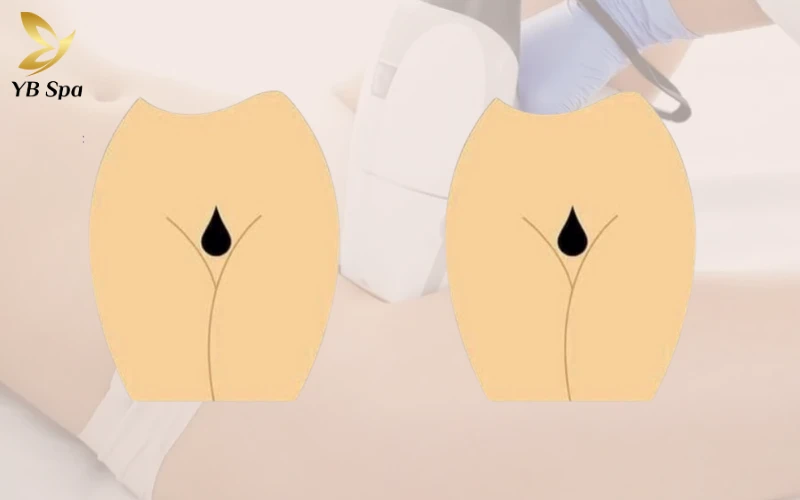 Triệt Lông Bikini Tạo Hình Là Gì? Các Mẫu Tạo Hình Triệt Lông Bikini Phổ Biến 30 Triệt Lông Bikini Tạo Hình Giọt Nước