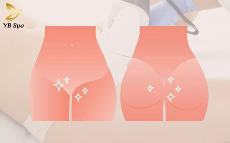 Triệt Lông Bikini Tạo Hình Là Gì? Các Mẫu Tạo Hình Triệt Lông Bikini Phổ Biến 31 Triệt Lông Bikini Tạo Hình Kiểu Hollywood