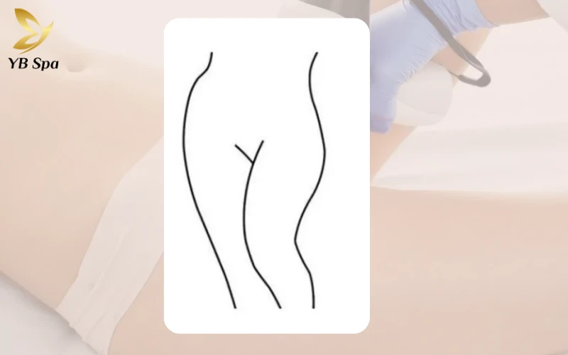 Triệt Lông Bikini Tạo Hình Là Gì? Các Mẫu Tạo Hình Triệt Lông Bikini Phổ Biến 32 Triệt Lông Bikini Tạo Hình Phong Cách Playboy