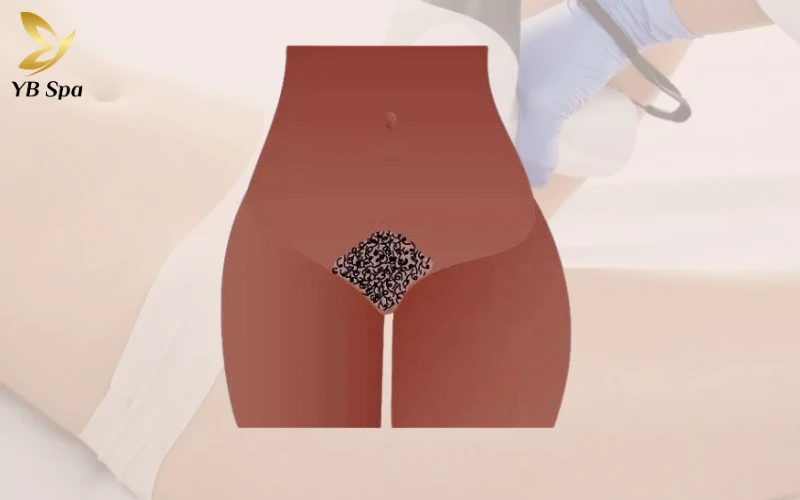 Triệt Lông Bikini Tạo Hình Là Gì? Các Mẫu Tạo Hình Triệt Lông Bikini Phổ Biến 33 Triệt Lông Bikini Tạo Hình Kiểu Bụi Rậm