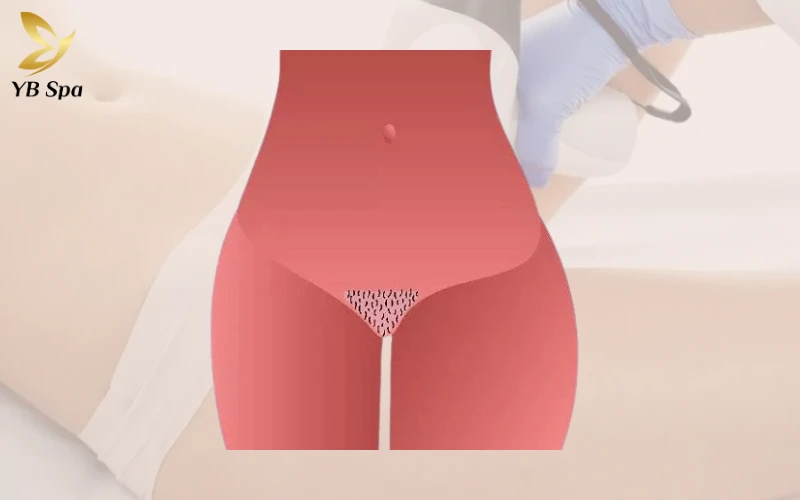 Triệt Lông Bikini Tạo Hình Là Gì? Các Mẫu Tạo Hình Triệt Lông Bikini Phổ Biến 34 Triệt Lông Bikini Tạo Hình Ly Rượu Martini