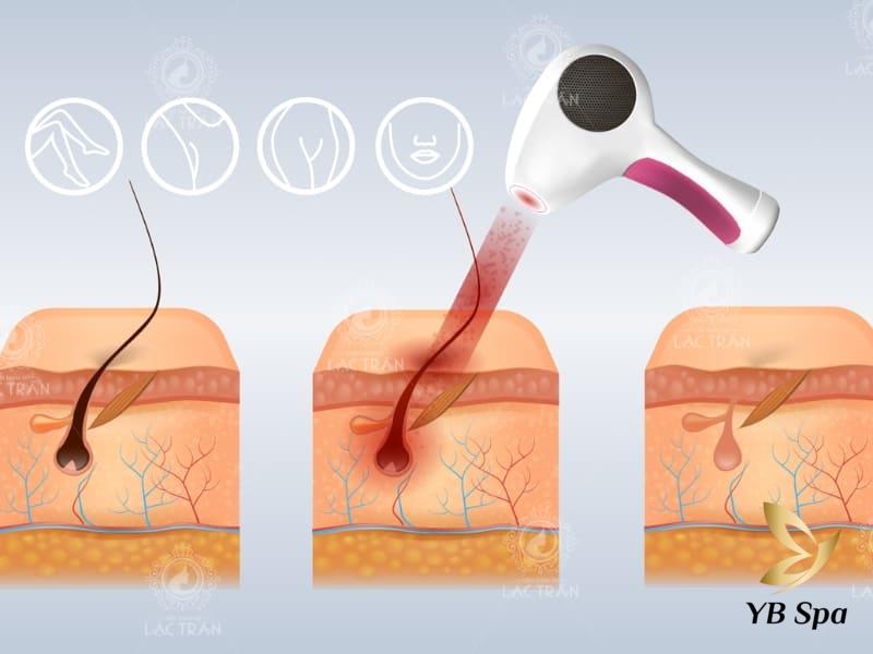 Triệt lông bằng Diode Laser có hại không? 21 Mô hình công nghệ các tia laser
