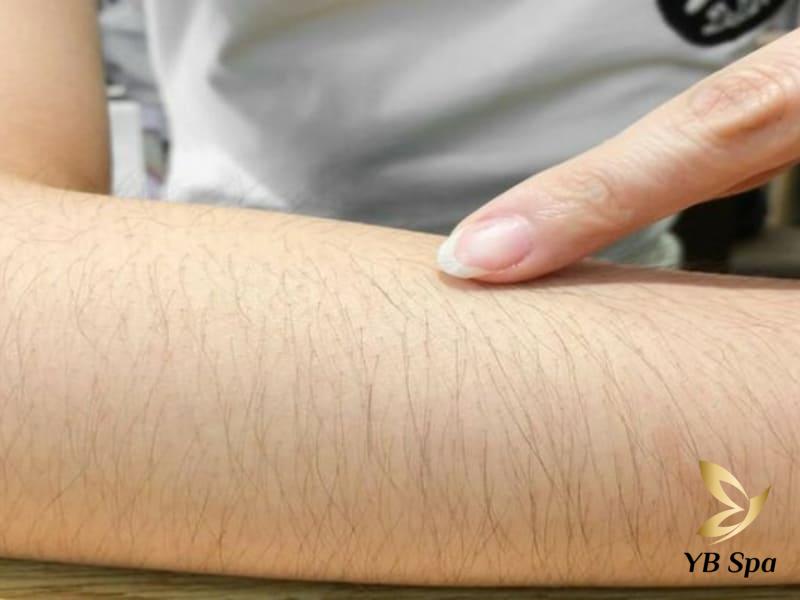 Triệt lông bằng Diode Laser có hại không? 23 Lông trên tay đậm dày