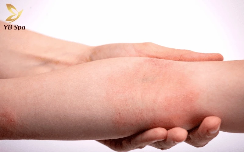 Tuyệt đối không sử dụng mỡ trăn trên các vùng da đang bị viêm nhiễm, mụn mủ hoặc có vết thương hở để tránh làm tình trạng nặng hơn