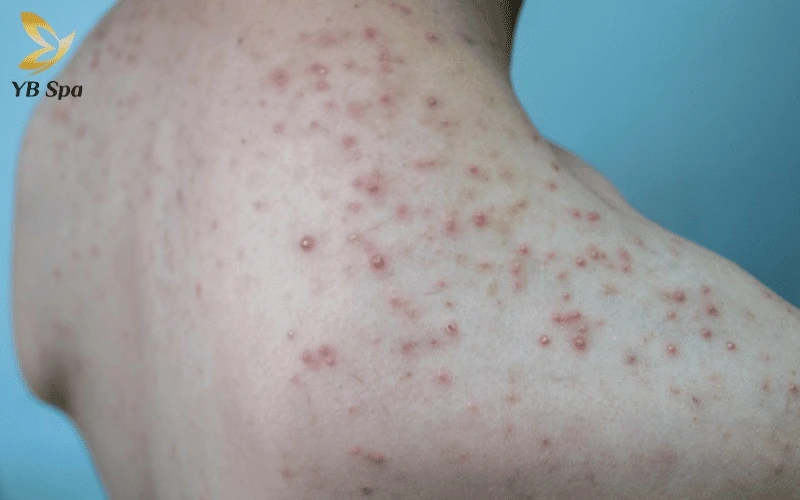 Tình trạng sưng đỏ và viêm nhiễm thường xuất phát từ thói quen để mỡ trăn lưu lại quá lâu trên da mà không được rửa sạch hoàn toàn.