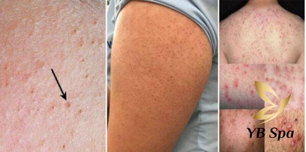 Triệt lông bị viêm nang lông là gì? (Nguồn: Internet)