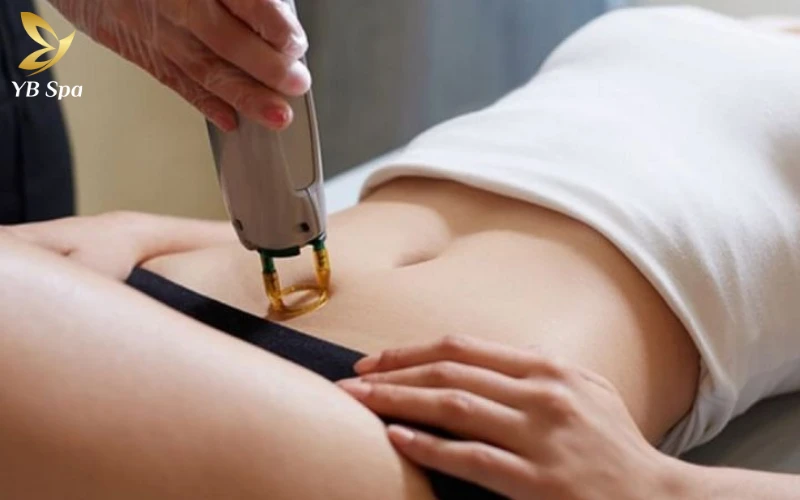 Triệt Lông Bikini