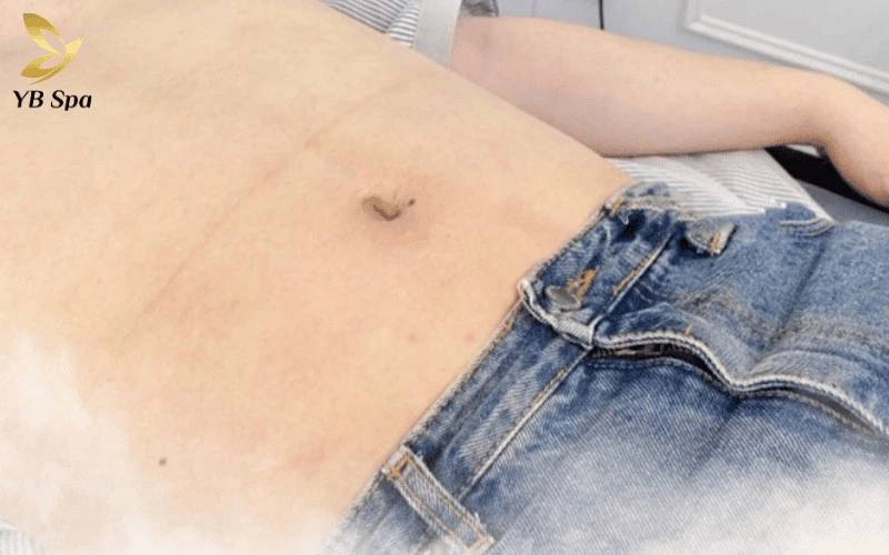 Chỉ sau 3-4 buổi, khách hàng có thể cảm nhận rõ rệt sự thay đổi khi sợi lông vùng bụng mọc thưa, mảnh và tự rụng dần