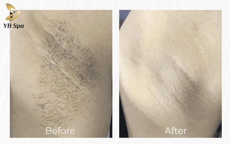 Khách hàng tại Cần Giờ phản hồi tích cực về hiệu quả triệt lông rõ rệt, sợi lông mọc lại thưa và mảnh chỉ sau 3-4 buổi.