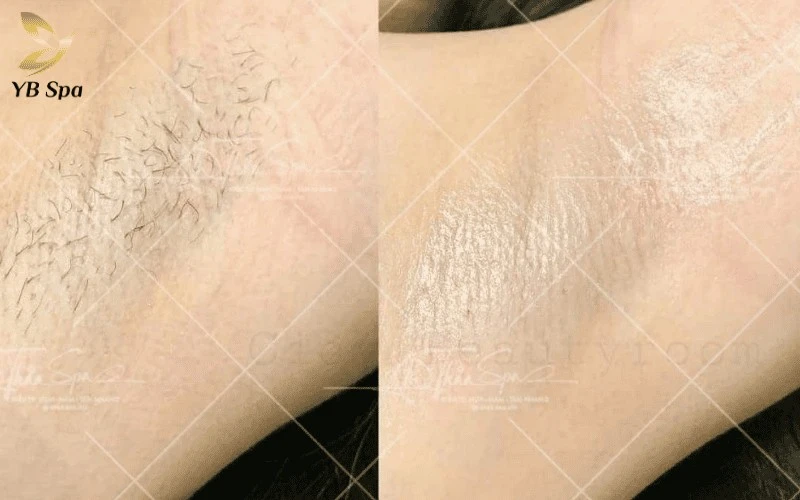 An Thảo Spa mang đến trải nghiệm triệt lông chuyên nghiệp với cam kết về hiệu quả thẩm mỹ và sự an toàn cho mọi loại da