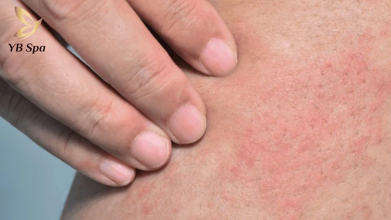 Triệt Lông Chân Có Ảnh Hưởng Gì Không? Rủi Ro Và Tác Dụng Phụ Tiềm Ẩn 10 Đỏ da hay kích ứng nhẹ là tác dụng phụ tạm thời sau khi triệt lông và sẽ tự hết