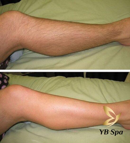 Nên lưu ý sau khi triệt lông chân nam vĩnh viễn (Nguồn: Internet)