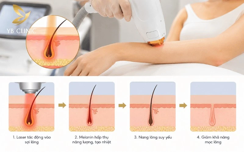 Triệt Lông Có Ảnh Hưởng Gì Không? Giải Đáp Và Lưu Ý An Toàn 8 Triệt lông có ảnh hưởng gì không? Công nghệ laser hiện đại tác động chọn lọc vào nang lông, giúp giảm lông lâu dài mà hạn chế ảnh hưởng đến vùng da xung quanh.