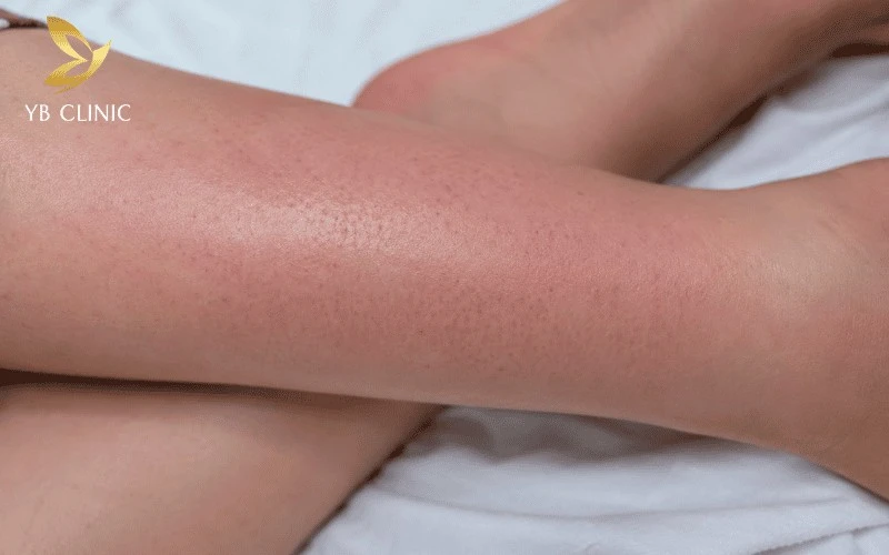 Triệt Lông Có Ảnh Hưởng Gì Không? Giải Đáp Và Lưu Ý An Toàn 9 Kích ứng và ửng đỏ tạm thời sau triệt lông bằng laser thường xuất hiện ở vùng da nhạy cảm và nhanh chóng biến mất nếu chăm sóc đúng cách.