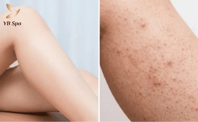 Triệt lông có bị viêm nang lông không? Nguyên nhân và cách phòng ngừa rủi ro 1
