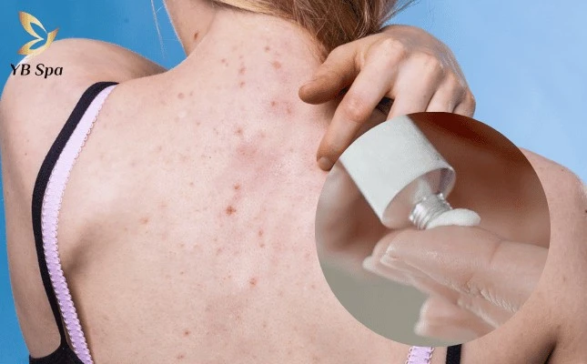 Thoa kem đặc trị giúp làm dịu và phục hồi vùng da bị viêm nang lông nhanh chóng.