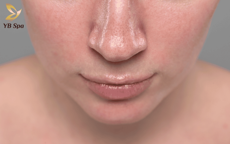 Hiện tượng Erythema là dấu hiệu cho thấy nang lông đã hấp thụ nhiệt năng hiệu quả để đạt kết quả tối ưu