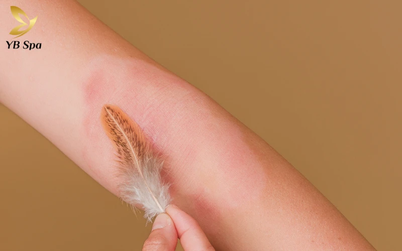 Luôn tham khảo ý kiến chuyên gia nếu bạn đang gặp các vấn đề về da nhạy cảm với ánh sáng trước khi bắt đầu liệu trình