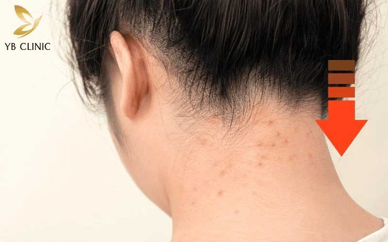 Triệt Lông Gáy Cho Nam Và Nữ Có Nên Không? Lợi Ích Và Rủi Ro Cần Biết 7 Triệt lông gáy giúp làm suy yếu nang lông, hạn chế bít tắc lỗ chân lông và hỗ trợ cải thiện tình trạng viêm nang lông.
