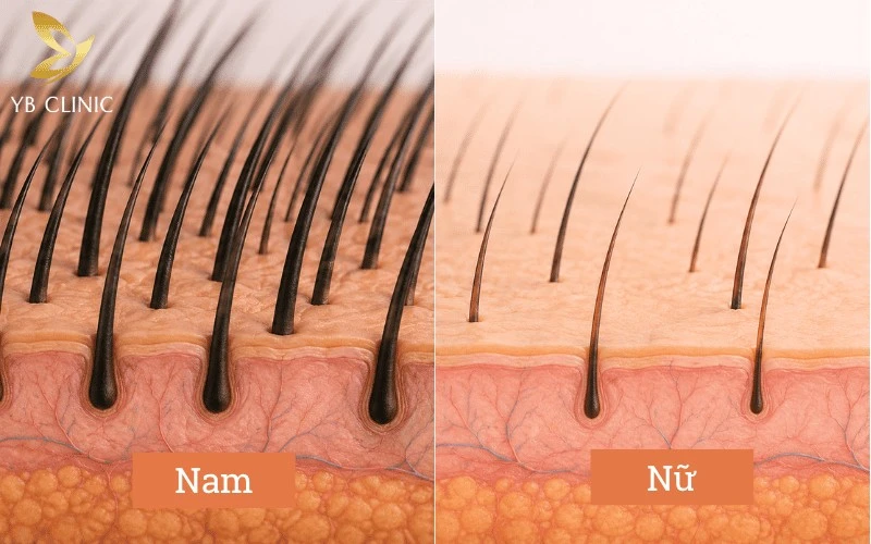 Triệt Lông Gáy Cho Nam Và Nữ Có Nên Không? Lợi Ích Và Rủi Ro Cần Biết 9 Đặc điểm nang lông nam giới cần công nghệ triệt có bước sóng phù hợp để tác động sâu, xử lý hiệu quả sợi lông dày và cứng vùng gáy.