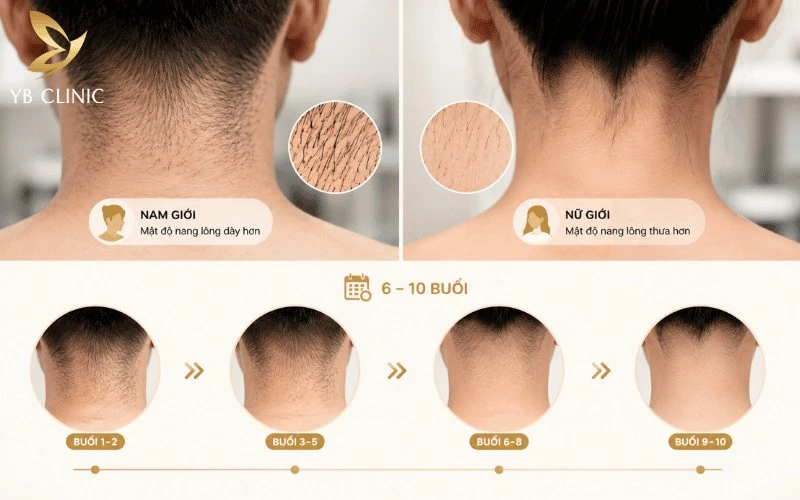 Triệt Lông Gáy Cho Nam Và Nữ Có Nên Không? Lợi Ích Và Rủi Ro Cần Biết 10 Liệu trình triệt lông gáy thường cần 6–10 buổi tùy cơ địa, giúp tác động theo chu kỳ phát triển của lông và xử lý dần các nang lông từ mảnh đến sâu, cứng đầu.