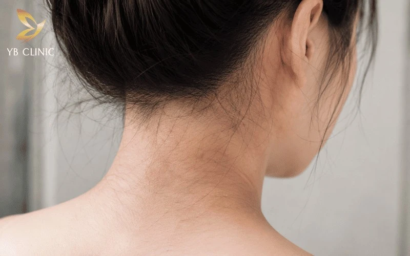 Triệt Lông Gáy Cho Nam Và Nữ Có Nên Không? Lợi Ích Và Rủi Ro Cần Biết 11 Tăng sắc tố có thể xuất hiện khi da vùng gáy sau triệt bị kích ứng và tiếp xúc với tia UV mà không được bảo vệ đúng cách.