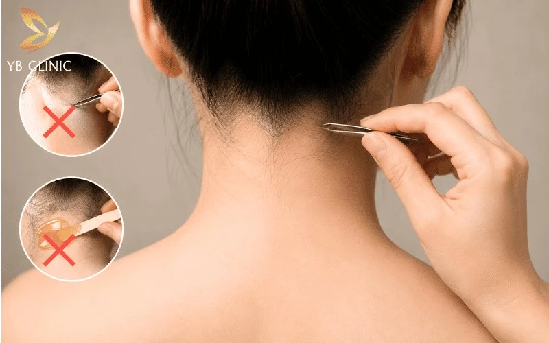 Triệt Lông Gáy Cho Nam Và Nữ Có Nên Không? Lợi Ích Và Rủi Ro Cần Biết 12 Không nhổ hoặc wax lông gáy trong liệu trình giúp duy trì gốc nang lông, đảm bảo ánh sáng tác động chính xác và tối ưu hiệu quả triệt.