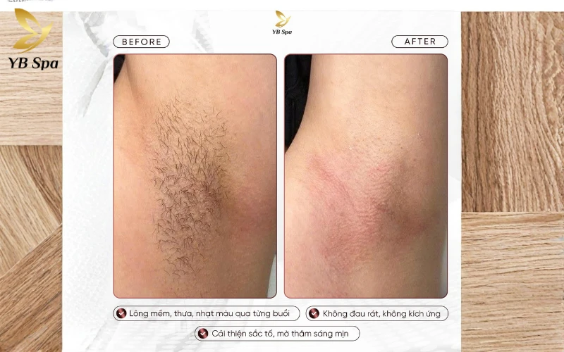 Triệt lông hàn băng là gì? Cơ chế hoạt động của triệt lông hàn băng 29 Hiệu quả được kiểm chứng bởi hàng nghìn khách hàng