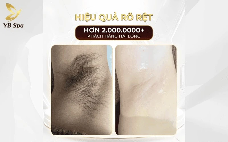 Chỉ sau 3-5 buổi, các sợi lông sẽ mọc thưa mảnh hơn hẳn, trả lại cho bạn làn da mịn màng và tự tin hơn mỗi ngày
