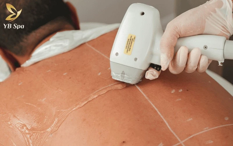 Tạm biệt nỗi lo mụn lưng và bí bách với danh sách 6 spa triệt lông lưng tại TP.HCM