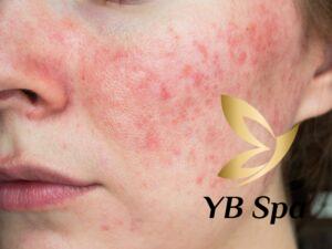 Da bị kích ứng sau khi triệt lông (Nguồn: Internet)