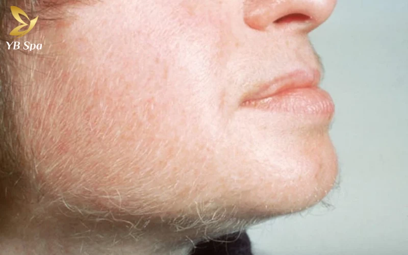 Triệt lông mặt là "cứu cánh" hoàn hảo cho những ai có lớp lông tơ dày và đậm màu gây mất thẩm mỹ