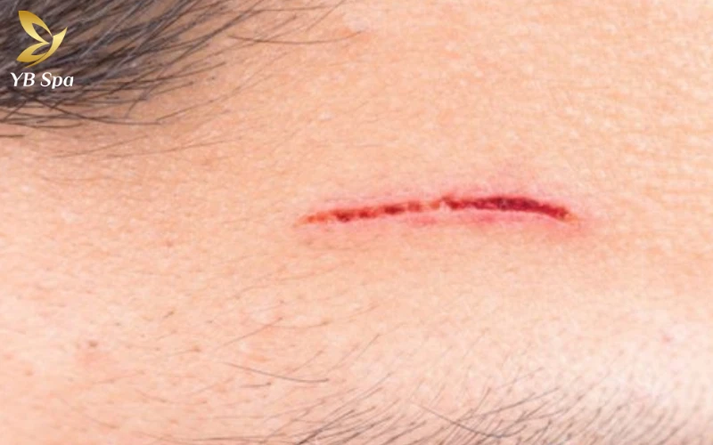 Tuyệt đối không thực hiện triệt lông khi da đang có vết thương hở để tránh gây kích ứng hoặc tổn thương sâu hơn