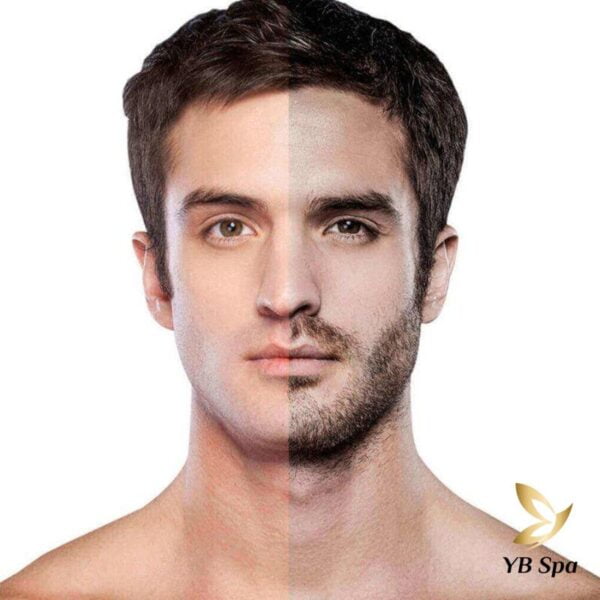 triệt lông mặt cho nam