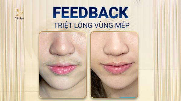 Trước và sau khi triệt lông mép bằng công nghệ laser