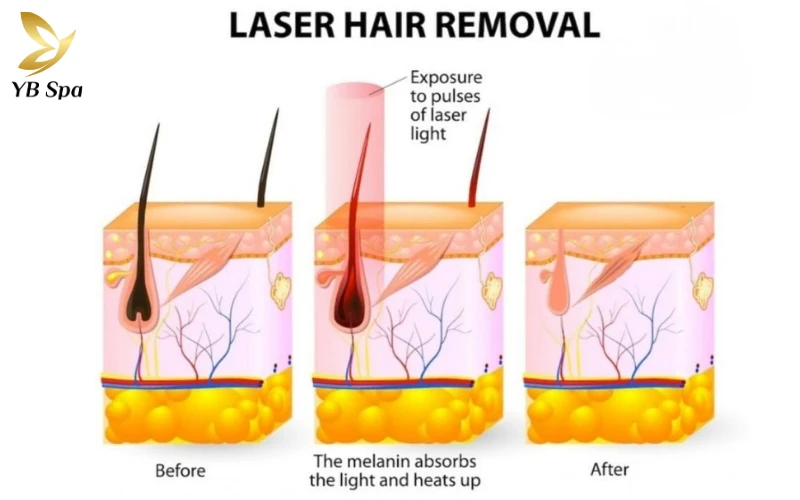 Nguyên lý quang nhiệt chọn lọc giúp Laser loại bỏ mầm mống nang lông một cách thông minh và an toàn tuyệt đối