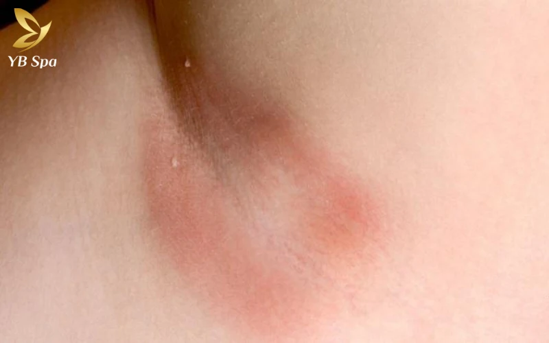 Đừng chủ quan trước cảm giác bỏng rát quá mức, vì đây là tín hiệu cho thấy làn da của bạn đang cần sự can thiệp chuyên sâu