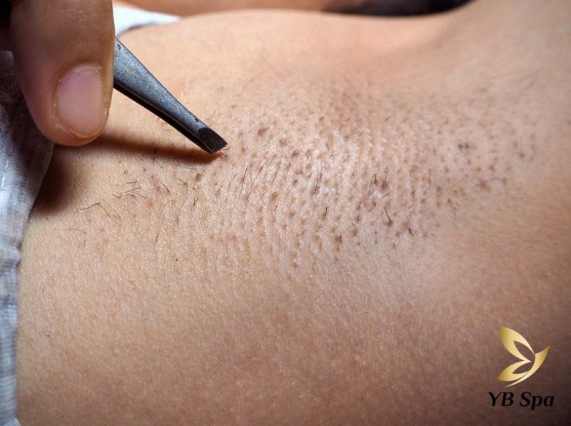 Triệt Lông Nách Bị Hôi Nách Phải Làm Sao? 21 Nhổ lông nách sai cách có thể gây hôi nách