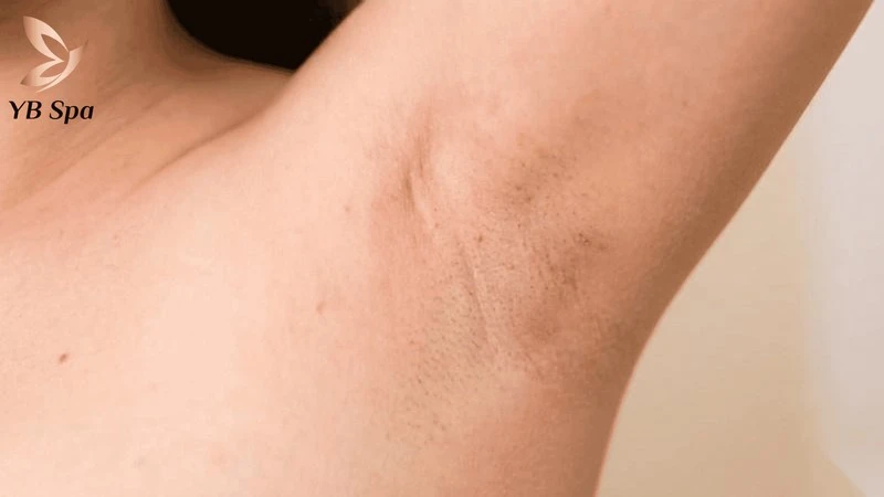 Da nách hơi đỏ và kích ứng nhẹ sau triệt lông là phản ứng sinh lý hết sức bình thường.